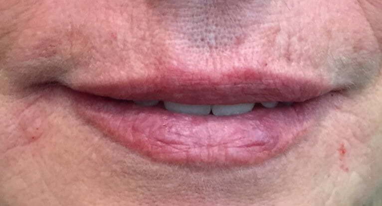 Picture of mouth after dermal fillers