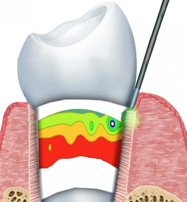 Laser Bacterial Reduction - Farnham Dentistry Jacksonville